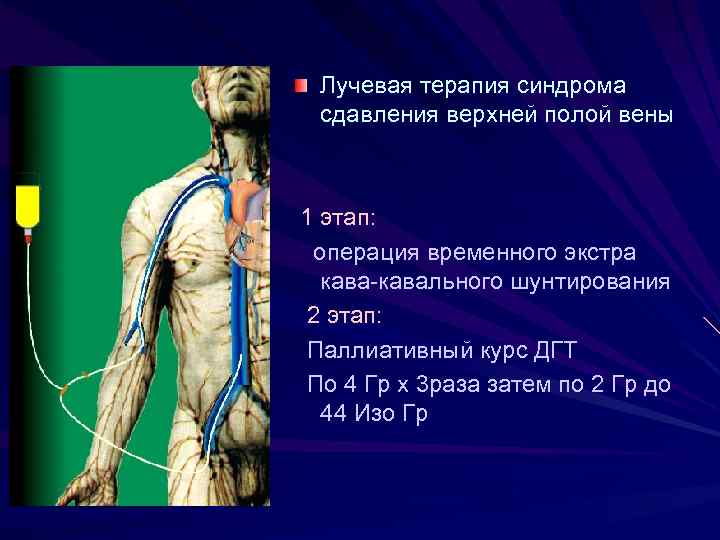 Лучевая терапия синдрома сдавления верхней полой вены 1 этап: операция временного экстра кава-кавального шунтирования
