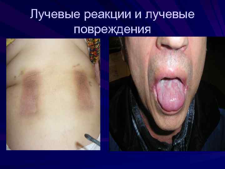 Лучевые реакции и лучевые повреждения 