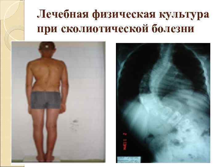 Лечебная физическая культура при сколиотической болезни 