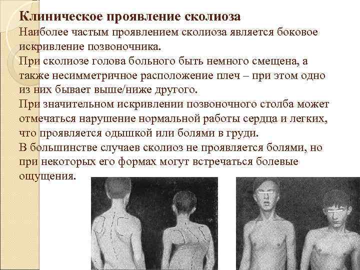Клиническое проявление сколиоза Наиболее частым проявлением сколиоза является боковое искривление позвоночника. При сколиозе голова