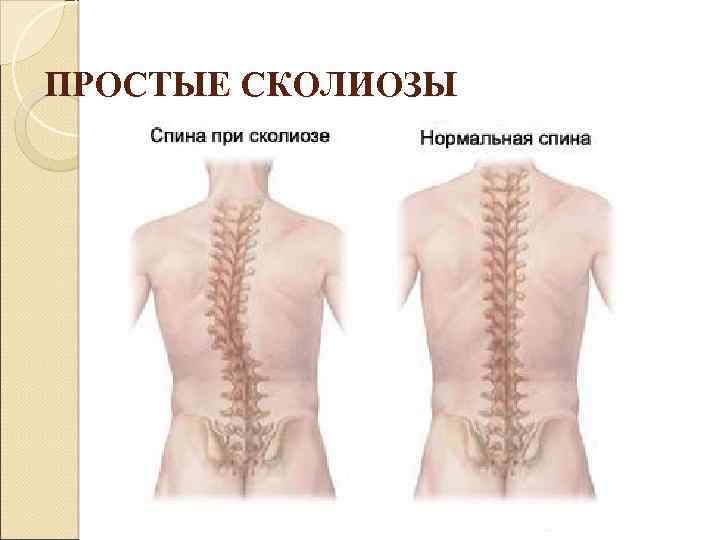 ПРОСТЫЕ СКОЛИОЗЫ 