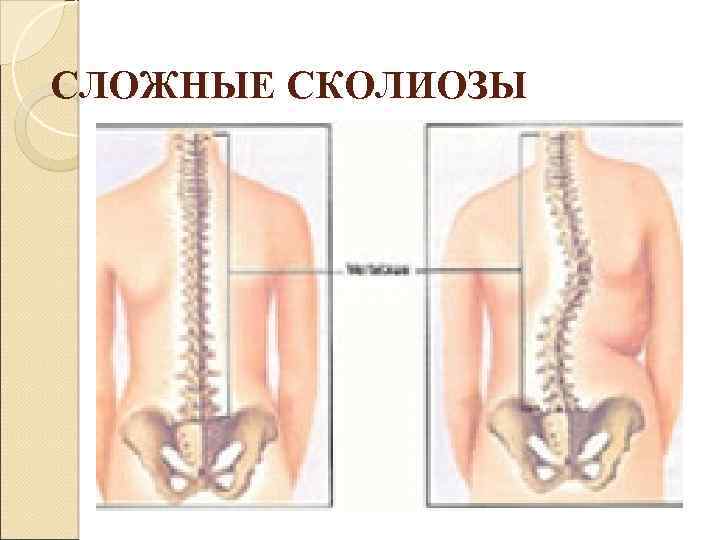 СЛОЖНЫЕ СКОЛИОЗЫ 