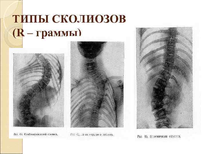 ТИПЫ СКОЛИОЗОВ (R – граммы) 