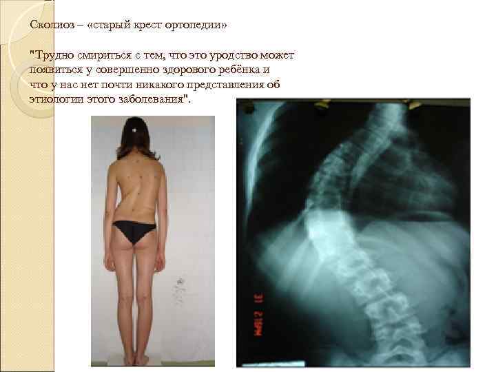 Сколиоз – «старый крест ортопедии» "Трудно смириться с тем, что это уродство может появиться