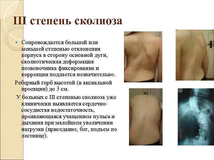 III степень сколиоза Сопровождается большей или меньшей степенью отклонения корпуса в сторону основной дуги,