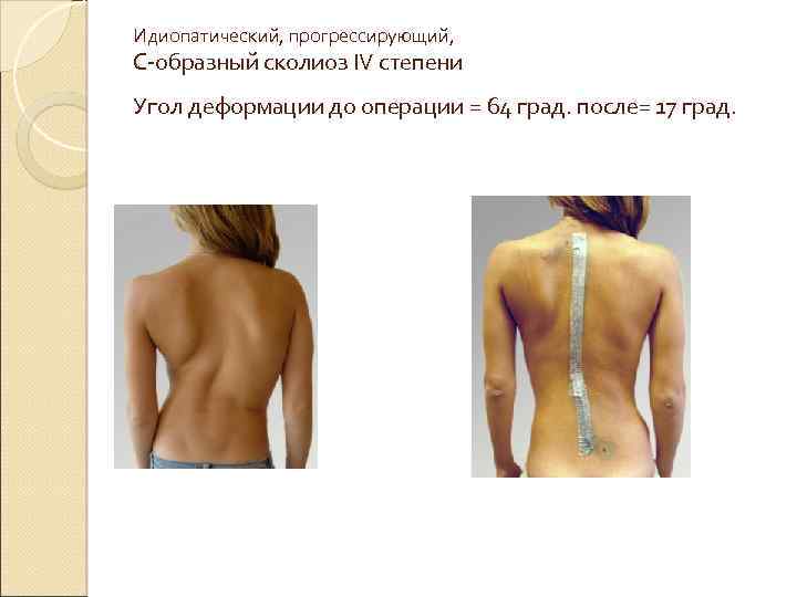 Идиопатический, прогрессирующий, С-образный сколиоз IV степени Угол деформации до операции = 64 град. после=