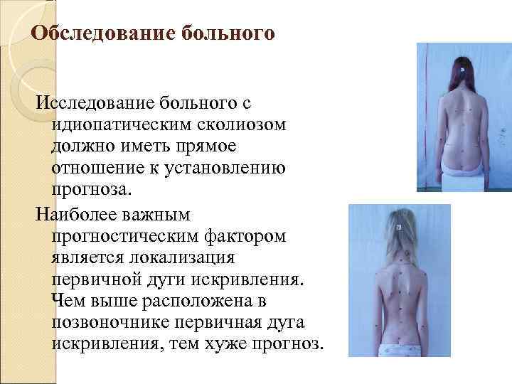 Обследование больного Исследование больного c идиопатическим сколиозом должно иметь прямое отношение к установлению прогноза.