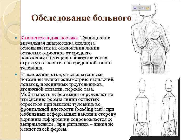 Обследование больного Клиническая диагностика. Традиционно визуальная диагностика сколиоза основывается на отклонении линии остистых отростков