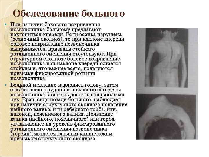 Обследование больного При наличии бокового искривления позвоночника больному предлагают наклониться кпереди. Если осанка нарушена