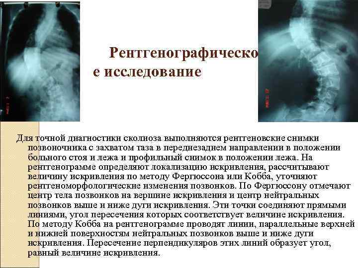 Рентгенографическо е исследование Для точной диагностики сколиоза выполняются рентгеновские снимки позвоночника с захватом таза