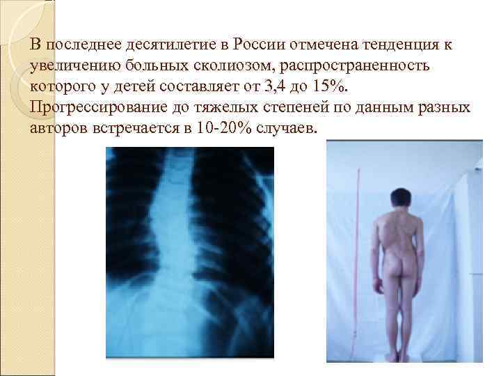 В последнее десятилетие в России отмечена тенденция к увеличению больных сколиозом, распространенность которого у