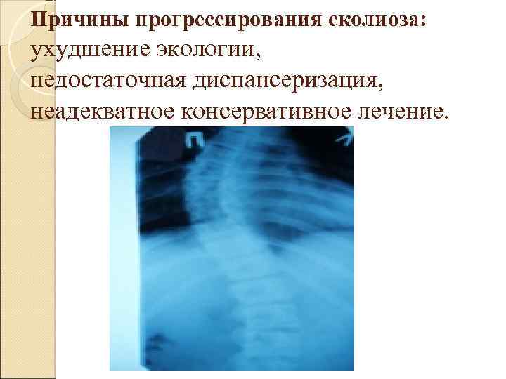 Причины прогрессирования сколиоза: ухудшение экологии, недостаточная диспансеризация, неадекватное консервативное лечение. 