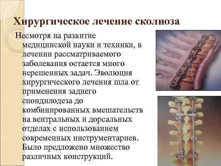 Хирургическое лечение сколиоза Несмотря на развитие медицинской науки и техники, в лечении рассматриваемого заболевания