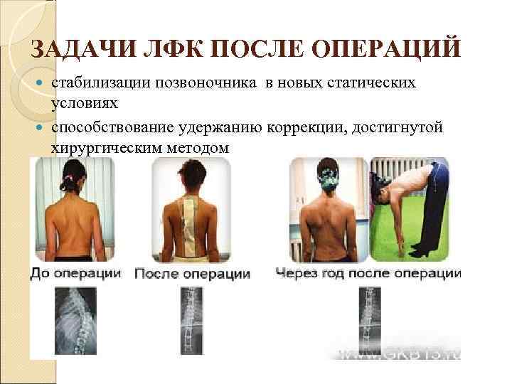ЗАДАЧИ ЛФК ПОСЛЕ ОПЕРАЦИЙ стабилизации позвоночника в новых статических условиях способствование удержанию коррекции, достигнутой