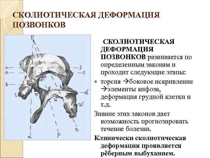 СКОЛИОТИЧЕСКАЯ ДЕФОРМАЦИЯ ПОЗВОНКОВ развивается по определенным законам и проходит следующие этапы: торсия боковое искривление