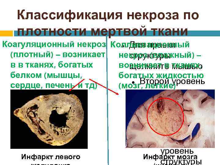 Классификация некроза по плотности мертвой ткани Коагуляционный некроз Колликвационный Для правки (плотный) – возникает