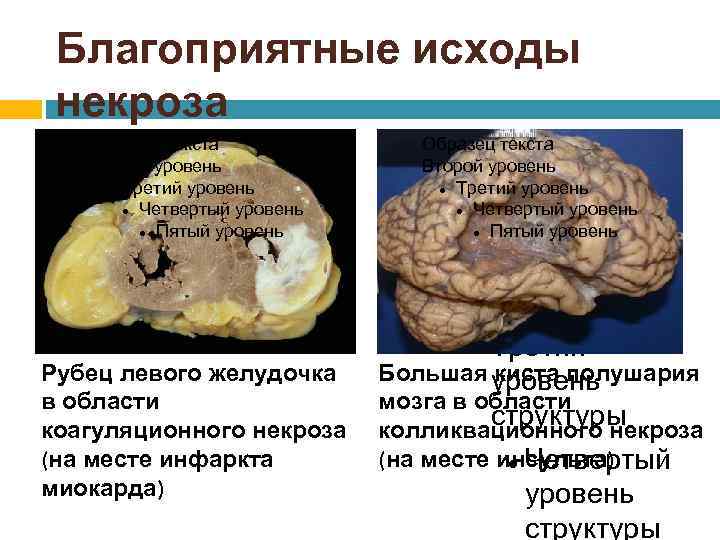 Благоприятные исходы некроза Образец текста Второй уровень Третий уровень Четвертый уровень Пятый уровень Для