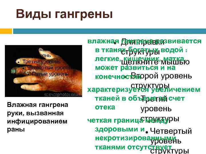 Виды гангрены Образец текста Второй уровень Третий уровень Четвертый уровень Пятый уровень Влажная гангрена