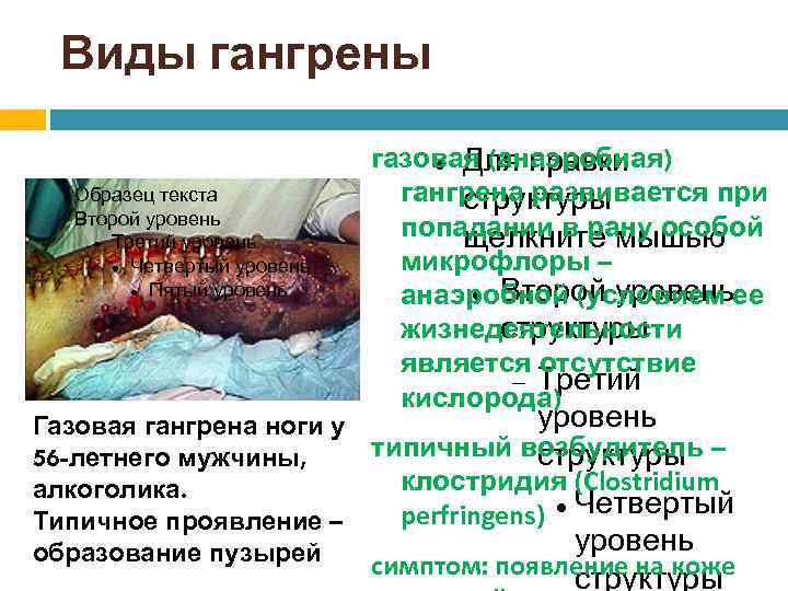 Виды гангрены Образец текста Второй уровень Третий уровень Четвертый уровень Пятый уровень газовая (анаэробная)