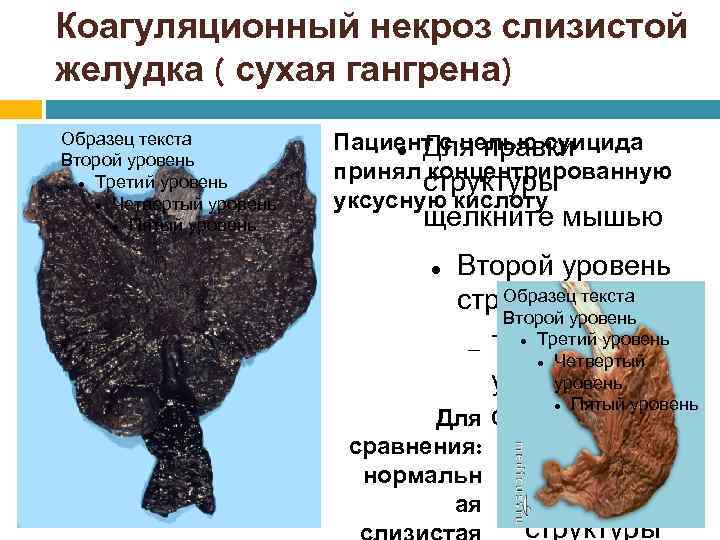 Коагуляционный некроз слизистой желудка ( сухая гангрена) Образец текста Второй уровень Третий уровень Четвертый