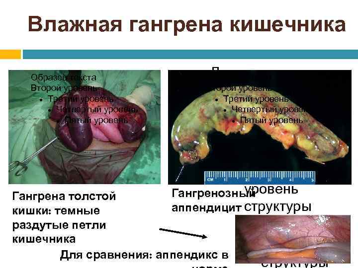 Влажная гангрена кишечника Образец текста Второй уровень Третий уровень Четвертый уровень Пятый уровень Для