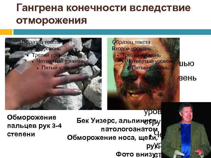 Гангрена конечности вследствие отморожения Образец текста Второй уровень Третий уровень Четвертый уровень Пятый уровень