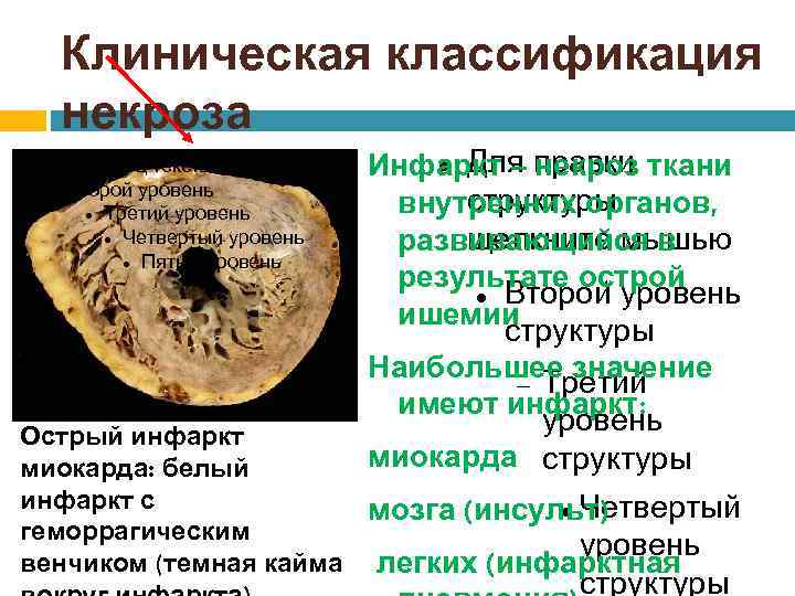 Клиническая классификация некроза Образец текста Второй уровень Третий уровень Четвертый уровень Пятый уровень Для