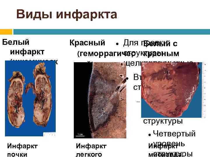 Виды инфаркта Белый инфаркт (ишемическ ий) Красный Для правки с Белый структуры (геморрагичес красным