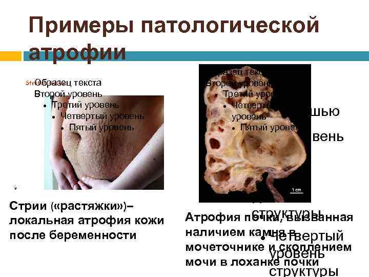 Примеры патологической атрофии Образец текста Второй уровень Третий уровень Четвертый уровень Пятый уровень Для