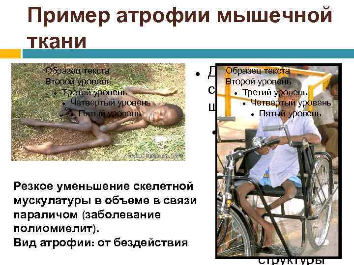 Пример атрофии мышечной ткани Образец текста Второй уровень Третий уровень Четвертый уровень Пятый уровень