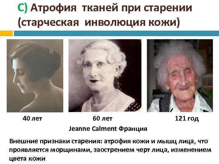 С) Атрофия тканей при старении (старческая инволюция кожи) 40 лет 60 лет Jeanne Calment