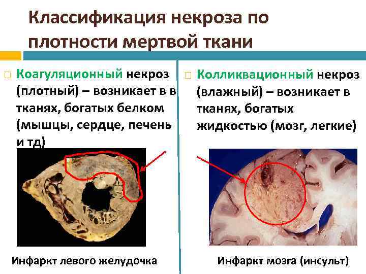 Классификация некроза по плотности мертвой ткани Коагуляционный некроз (плотный) – возникает в в тканях,