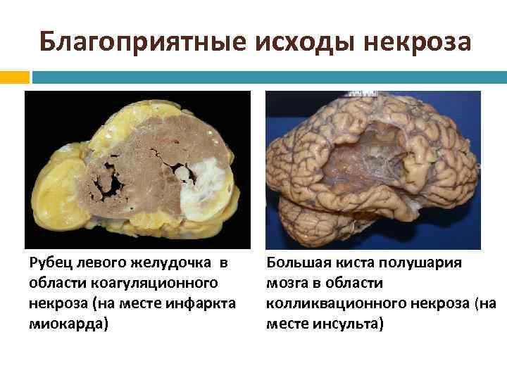 Благоприятные исходы некроза Рубец левого желудочка в области коагуляционного некроза (на месте инфаркта миокарда)