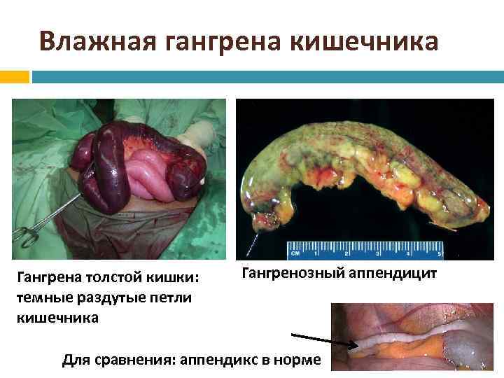 Влажная гангрена кишечника Гангрена толстой кишки: темные раздутые петли кишечника Гангренозный аппендицит Для сравнения: