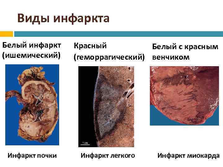 Виды инфаркта Белый инфаркт (ишемический) Инфаркт почки Красный Белый с красным (геморрагический) венчиком Инфаркт