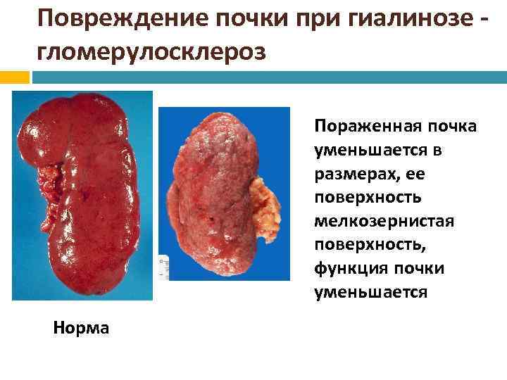 Повреждение почки при гиалинозе - гломерулосклероз Пораженная почка уменьшается в размерах, ее поверхность мелкозернистая