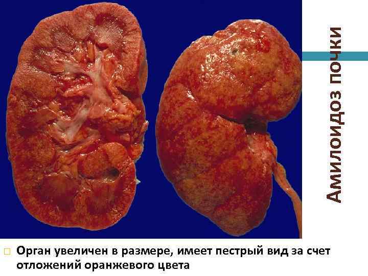Амилоидоз почки Орган увеличен в размере, имеет пестрый вид за счет отложений оранжевого цвета