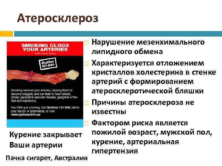 Атеросклероз Нарушение мезенхимального липидного обмена Характеризуется отложением кристаллов холестерина в стенке артерий с формированием