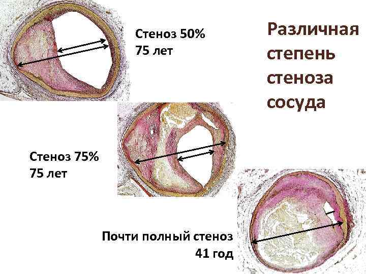 Стеноз 50% 75 лет Стеноз 75% 75 лет Почти полный стеноз 41 год Различная