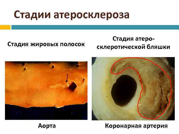 Стадии атеросклероза Стадия жировых полосок Аорта Стадия атеросклеротической бляшки Коронарная артерия 