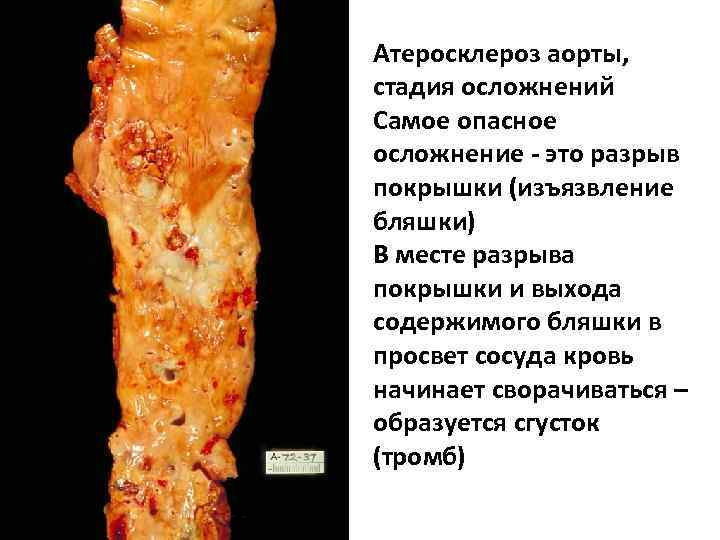 Атеросклероз аорты, стадия осложнений Самое опасное осложнение - это разрыв покрышки (изъязвление бляшки) В