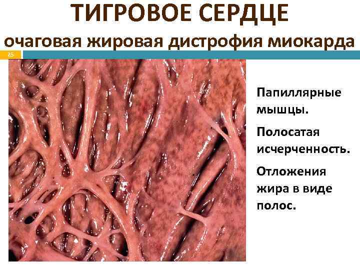 ТИГРОВОЕ СЕРДЦЕ очаговая жировая дистрофия миокарда 25 Папиллярные мышцы. Полосатая исчерченность. Отложения жира в