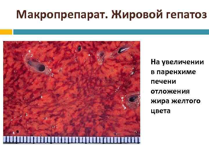 Макропрепарат. Жировой гепатоз На увеличении в паренхиме печени отложения жира желтого цвета 