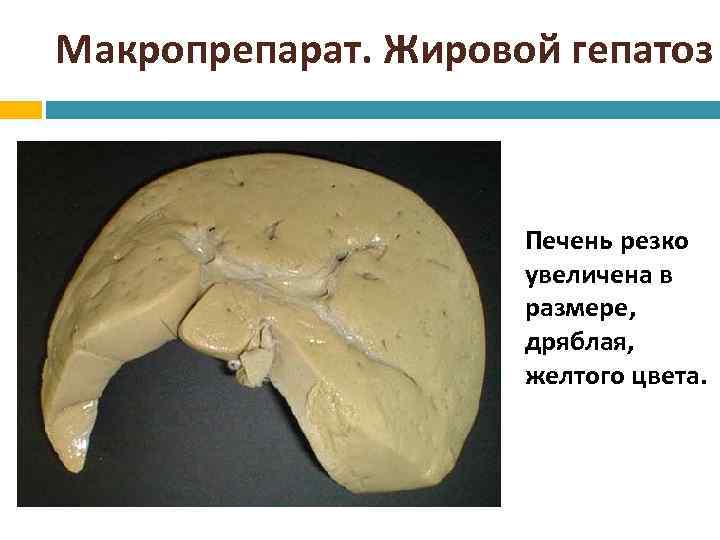 Макропрепарат. Жировой гепатоз Печень резко увеличена в размере, дряблая, желтого цвета. 
