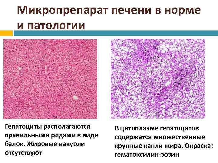 Процесс сопровождающийся накоплением в цитоплазме гепатоцитов