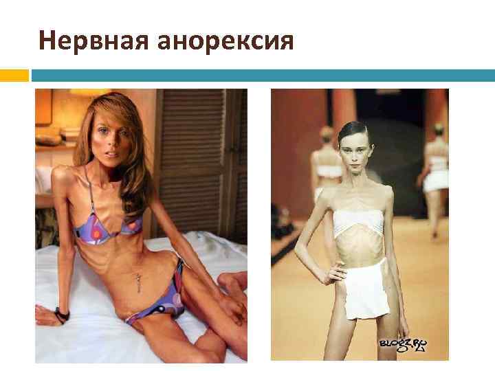Нервная анорексия 