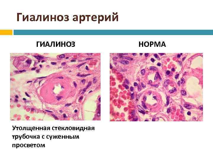 Гиалиноз относится к