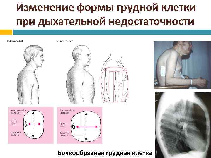 Изменение формы грудной клетки при дыхательной недостаточности Бочкообразная грудная клетка 