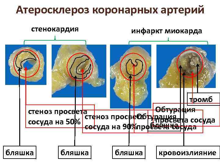 Атеросклероз коронарных артерий стенокардия инфаркт миокарда тромб Обтурация стеноз просвета сосуда Обтурация сосуда на