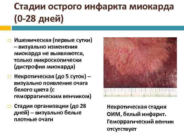 Стадии острого инфаркта миокарда (0 -28 дней) Ишемическая (первые сутки) – визуально изменения миокарда
